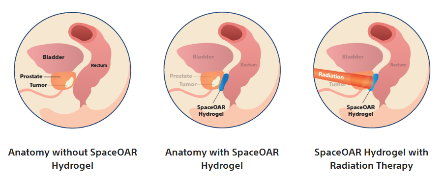 SpaceAOR Hydrogel Steps