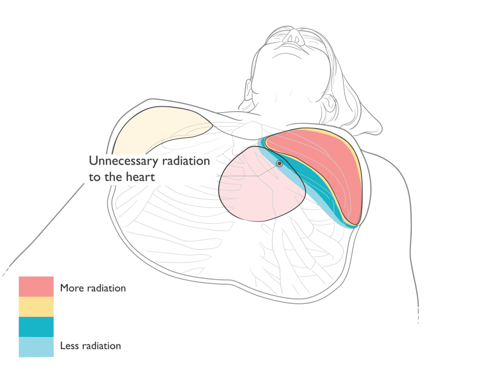 radiation therapy diagram