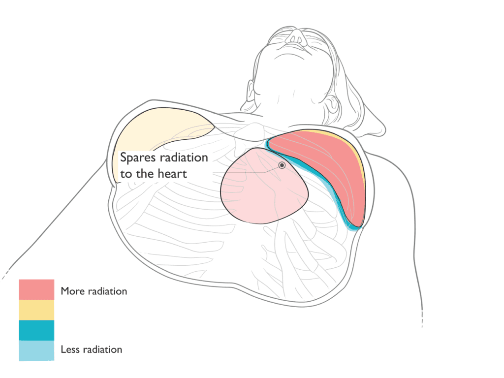 Proton Therapy Diagram