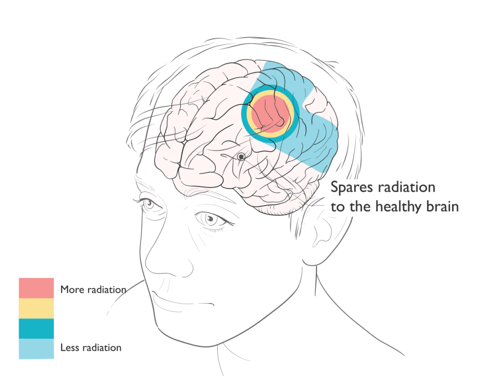 Proton Therapy for Brain Spine Cancer Illustration