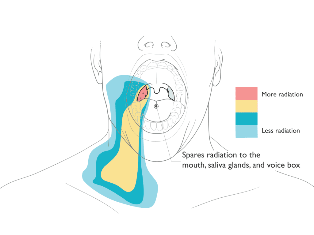 Proton Therapy for Head and Neck Cancer Illustration