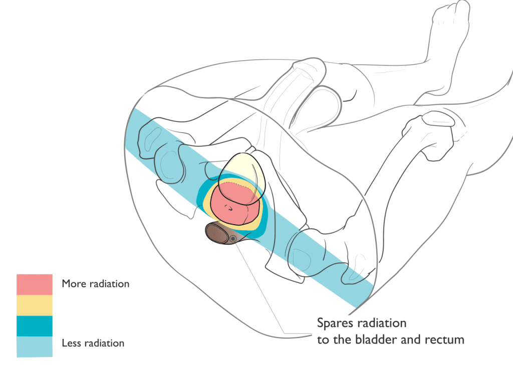 Proton Therapy for Prostate Cancer Illustration
