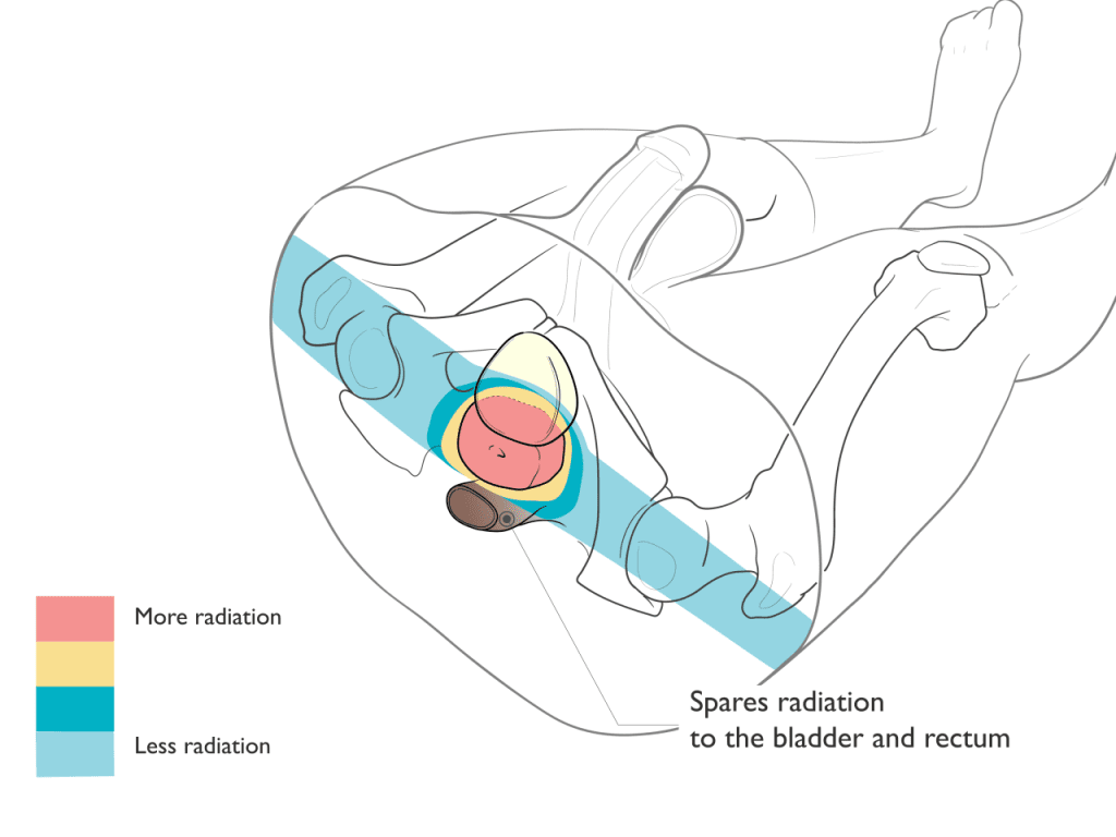 Prostate Cancer Radiation Treatment Emory Proton Therapy Center 0612