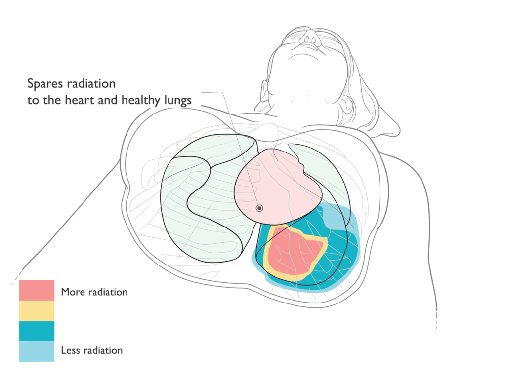 Proton Therapy for Thorcacic Cancer Illustration