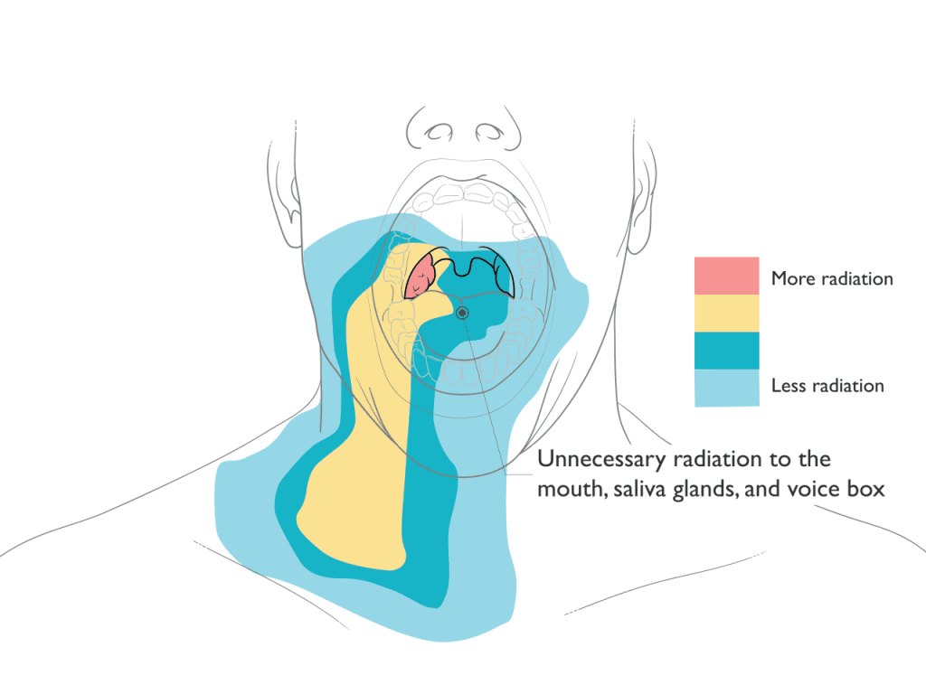 Xray Therapy for Head and Neck Cancer Illustration