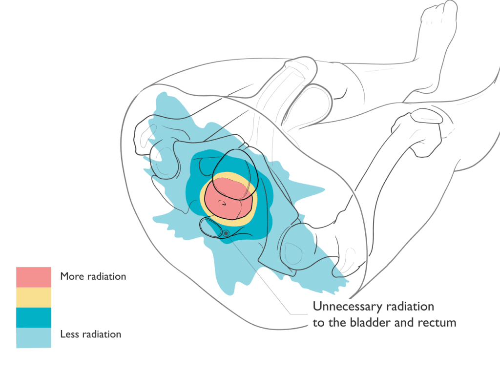 Xray Therapy for Prostate Cancer Illustration