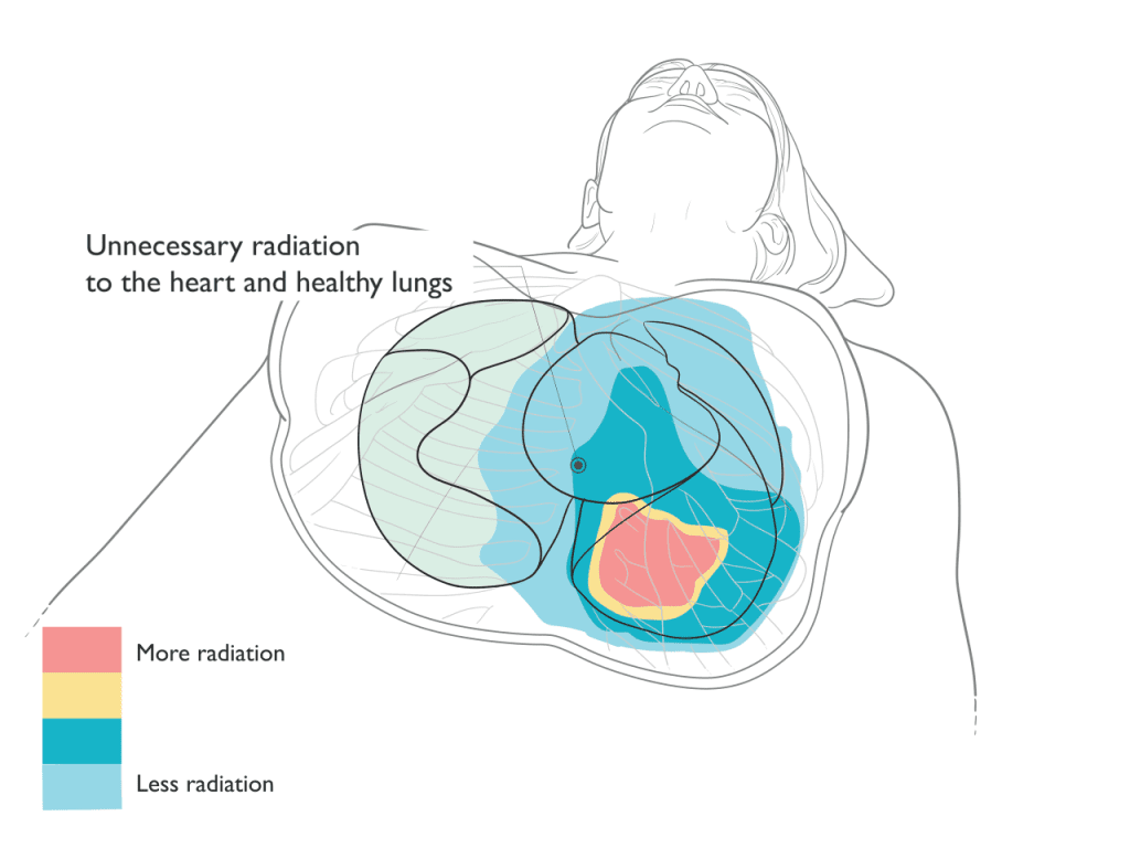 Xray Therapy for Thorcacic Cancer Illustration