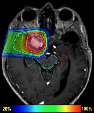 Meningioma Proton Treatment