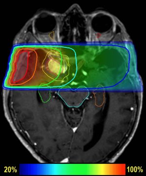 Meningioma-Xray-optimized